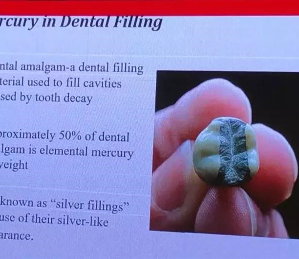 回顾|牙科银汞合金材料在我国的使用情况研讨会